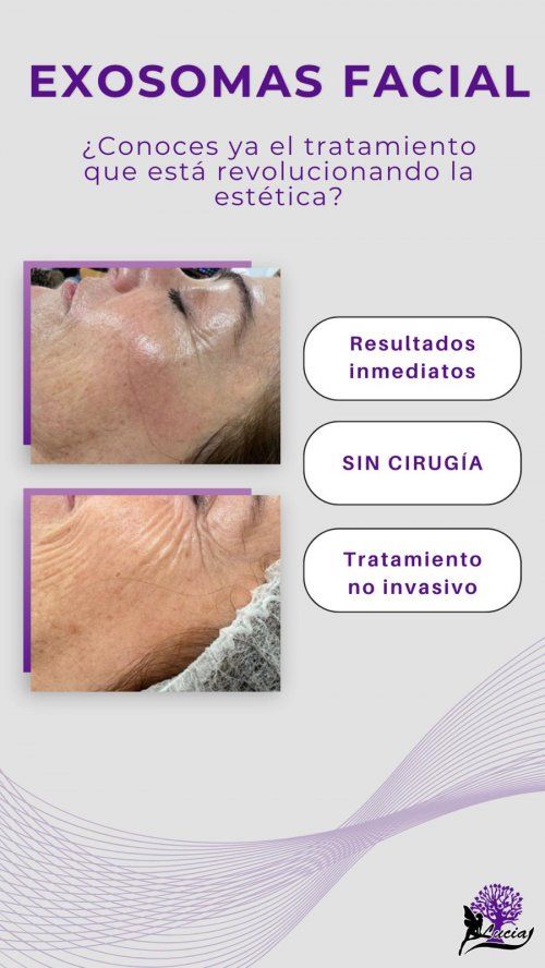 Tratamiento exosomas